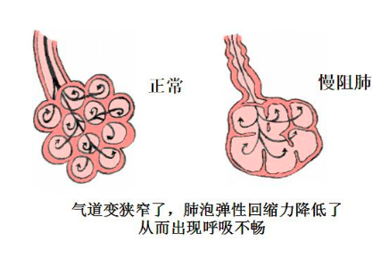 慢阻肺-痰多-咳痰-排痰-氣道廓清-康復(fù)-肺病-呼吸-肺功能檢測儀