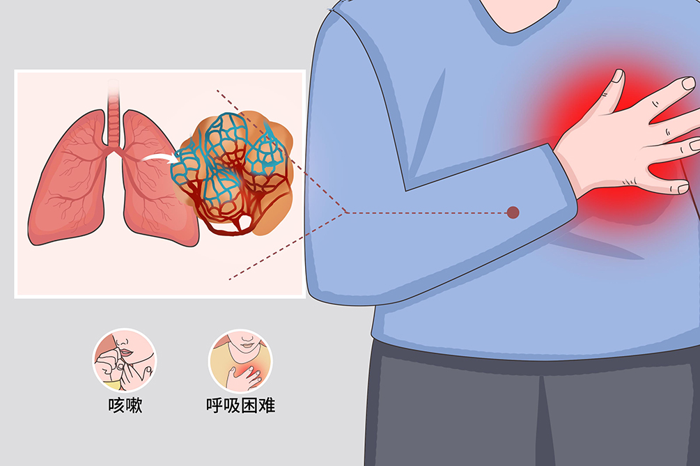 肺纖維化-肺炎-吸煙-特發(fā)性肺纖維化-肺功能-肺功能檢測儀-呼吸訓(xùn)練器-慢阻肺-哮喘-免疫力-咽炎-咳嗽-干咳-呼吸肌